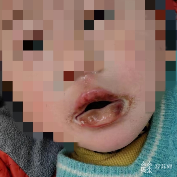开云 开云体育平台一岁男孩误食管道疏通剂后嘴被烧黄 医生：千万别催吐或用土法赶紧就医(图2)