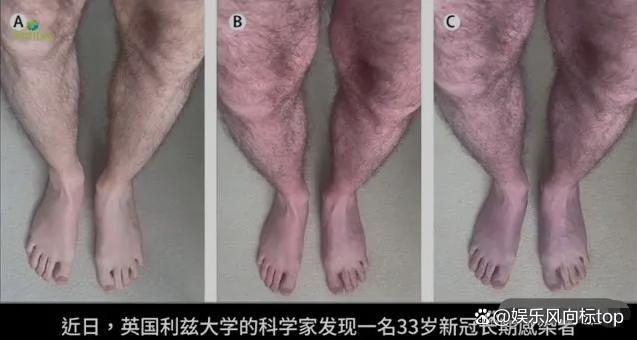 一英国人长期感染新冠导致腿变蓝 医学专家解析背后原理Kaiyun 开云体育(图3)